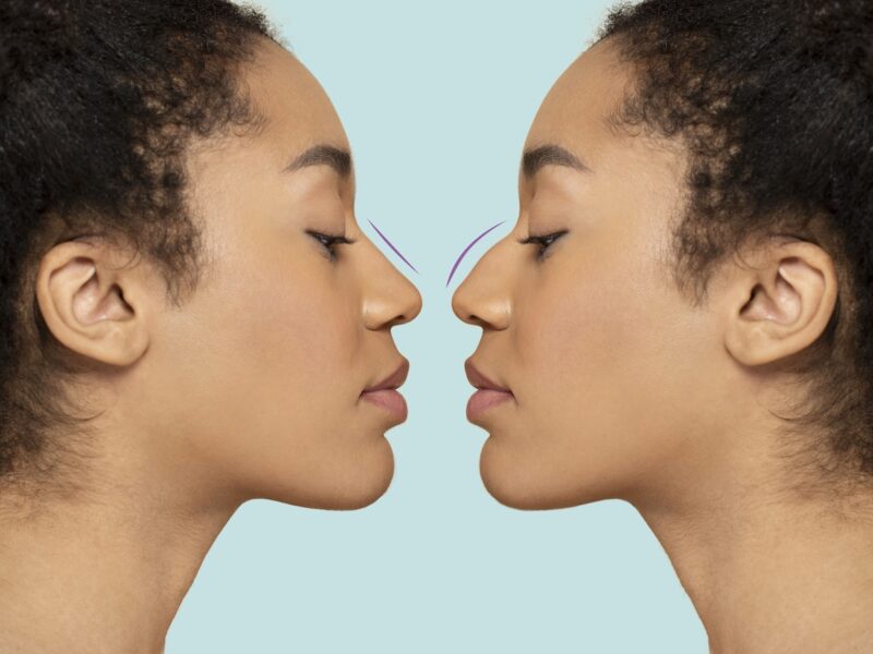 donna che si prepara a un intervento di rinosettoplastica